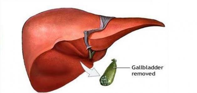 تجربتي مع استئصال المرارة ومتى نرجع طبيعي بعد العملية؟