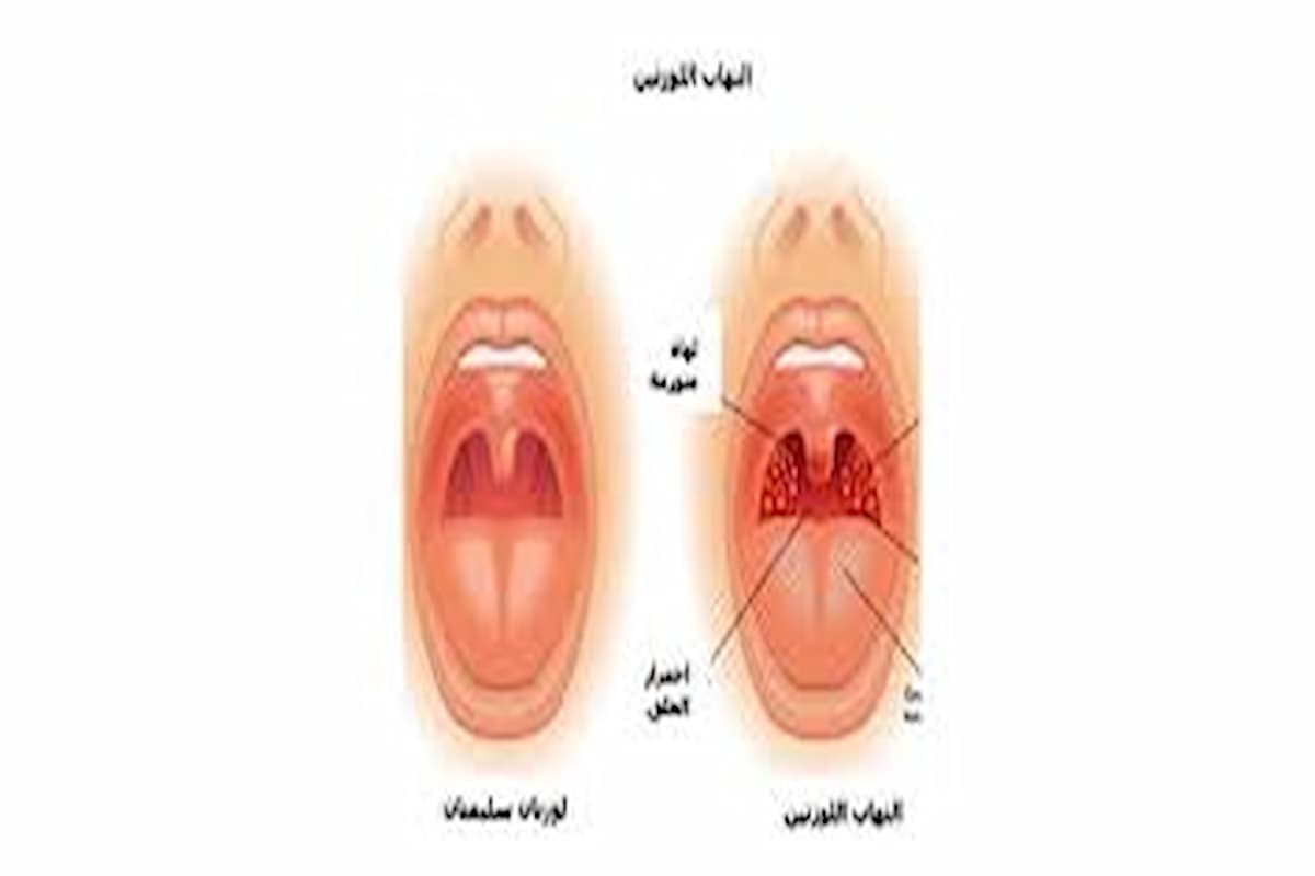 علاج التهاب اللوز في المنزل